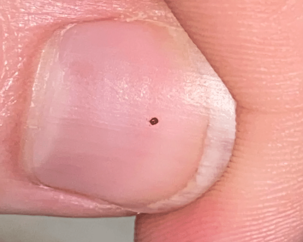 Can Bird Mites Infest Bedding